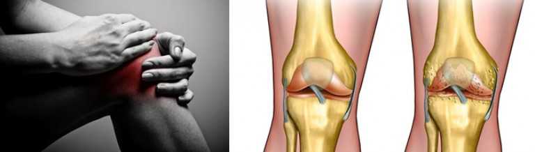 Упражнения при артрозе коленного сустава по методике бубновского