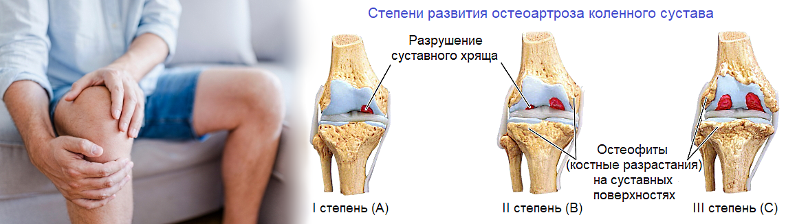 Лфк при артрозе коленного сустава: комплекс упражнений от врача