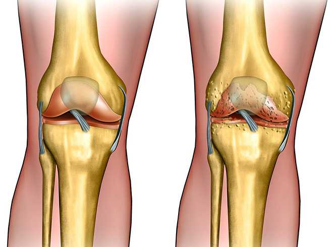 Памятка для спортсменов: почему болят колени после бега и что с этим делать? | артра